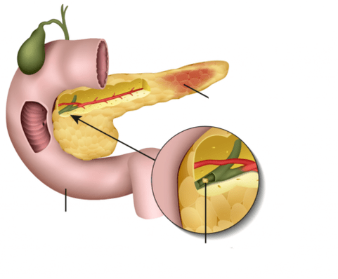 La pancreatite è un'infiammazione del pancreas